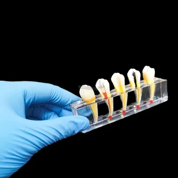 Эндодонтическая патологическая модель патологическая модель общения с пациентом Эндодонтическое лечение Восстановление пульпы на задних зубах